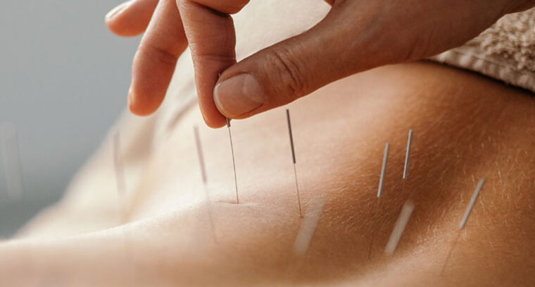 acupuncture banner