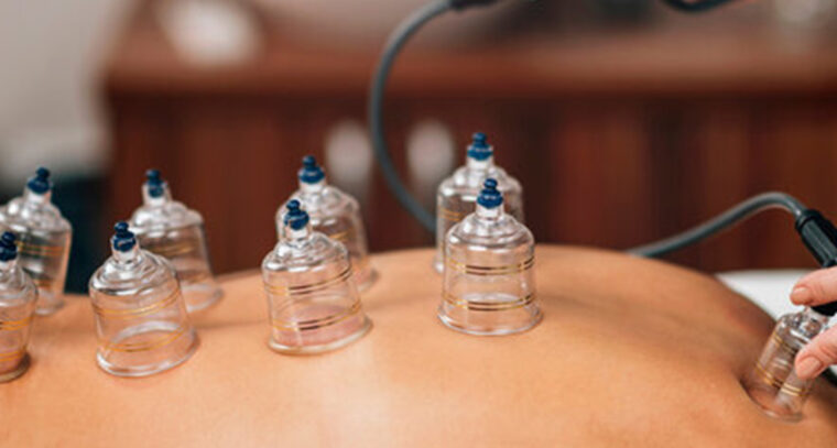 cupping2233